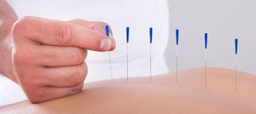 material acupuntura Dermocel